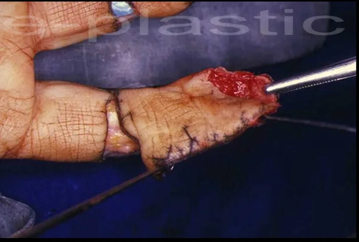 Avulsion pulpaire par meuleuse avec exposition osseuse, cas clinique 3