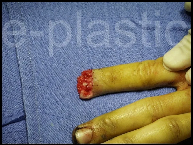 Vue peropératoire du marquage du lambeau d'éponychium, cas clinique 4