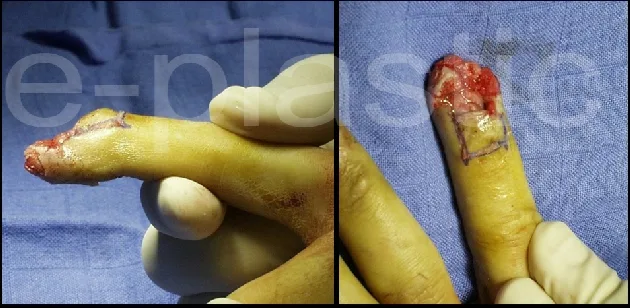 Zone rectangulaire désépidermisée et incisée, lambeau d'éponychium, cas clinique 4