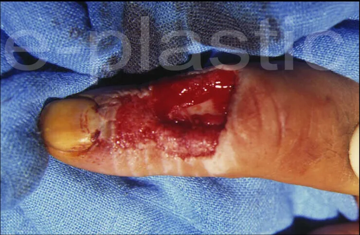 Repères cutanés, levée et réinsertion tendineuse, cas clinique 3