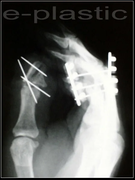 Contrôle radiographique post-opératoire, arthrodèse de l'IP du pouce, cas clinique 2