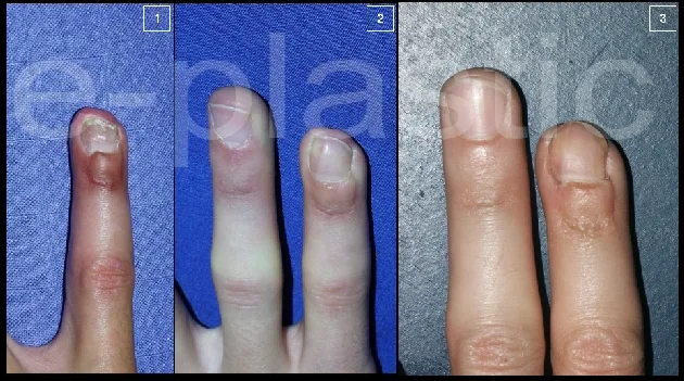 Évolution de l'ongle à 6 mois, 18 mois et 5 ans, cas clinique 4