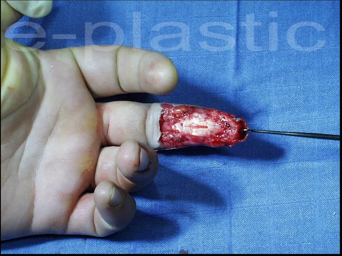 Avulsion de la face palmaire de P2-P3 du majeur par dégauchisseuse, cas clinique 4