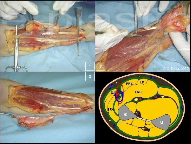Temps de dissection et coupe anatomique du lambeau antébrachial radial
