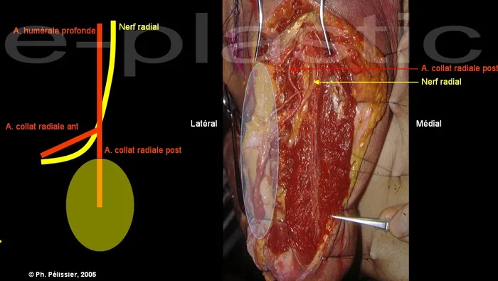Anatomie de l'artère collatérale radiale postérieure et du nerf radial