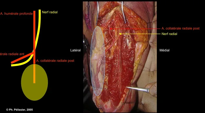 Anatomie de l'artère collatérale radiale postérieure et du nerf radial