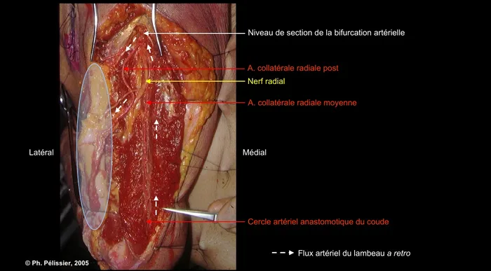Coupe transversale du bras avec cercle artériel anastomotique du coude