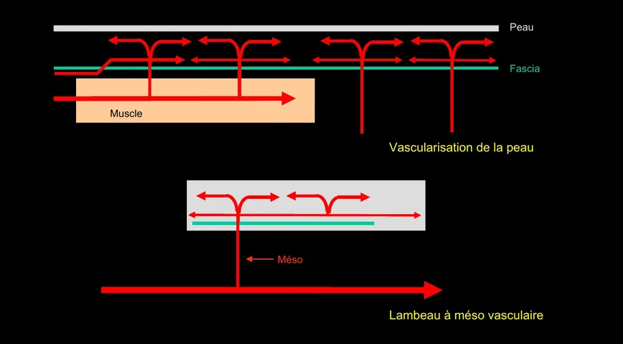 Schéma de la vascularisation de la peau et du lambeau à méso vasculaire