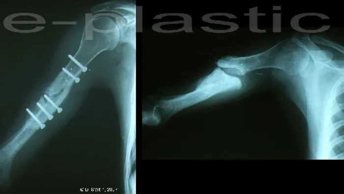 Lambeau de crête de scapula — figure 7