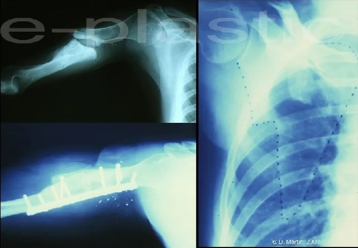 Lambeau de crête de scapula — figure 8