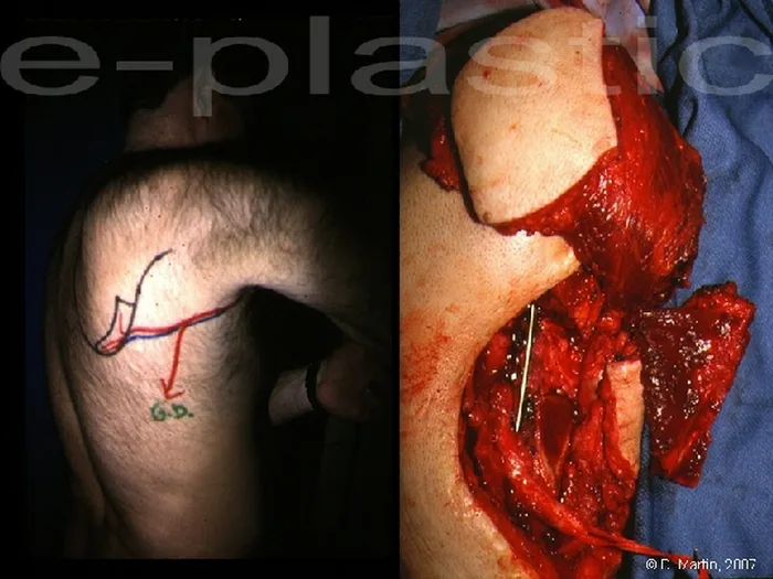 Lambeau de crête de scapula — figure 9