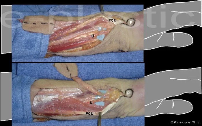 Dissection anatomique de l'artère cubito-dorsale entre l'ulna et le FCU