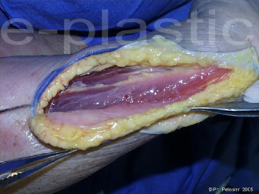 Dissection du pédicule du lambeau cubito-dorsal