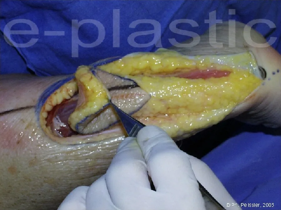 Levée du lambeau cubito-dorsal de proximal en distal