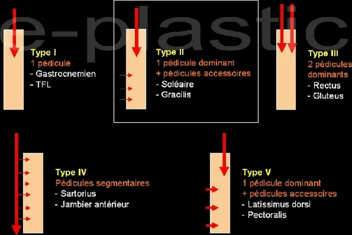 Lambeau de gracilis — figure 1