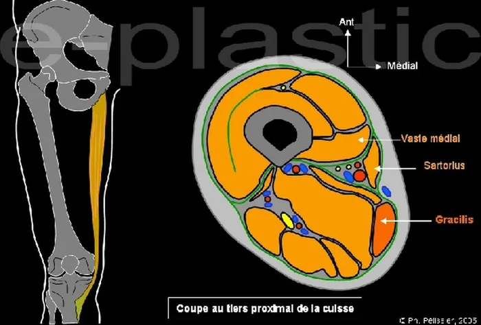 Lambeau de gracilis — figure 2