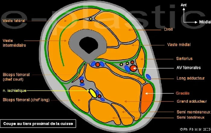 Lambeau de gracilis — figure 3