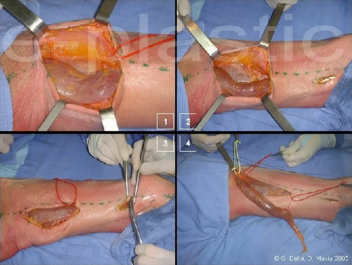 Lambeau de gracilis — figure 4