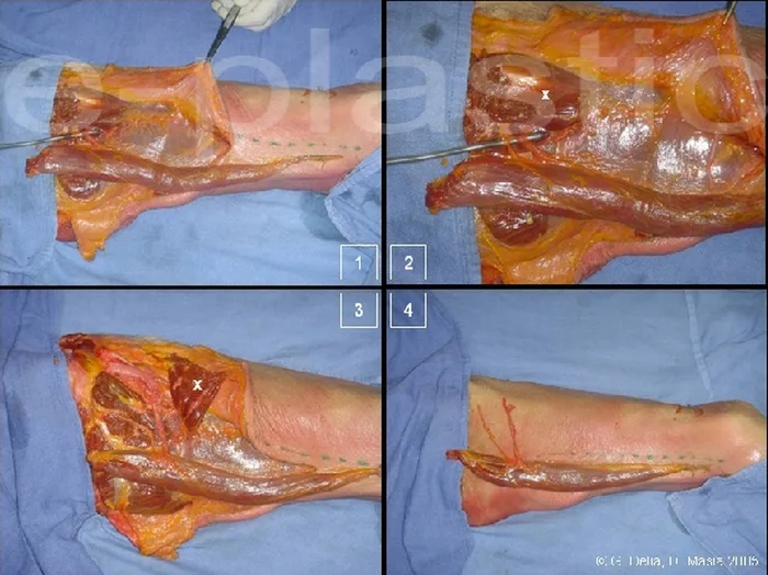 Lambeau de gracilis — figure 6