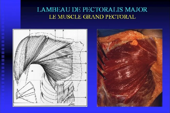 Lambeau de pectoralis major — figure 3