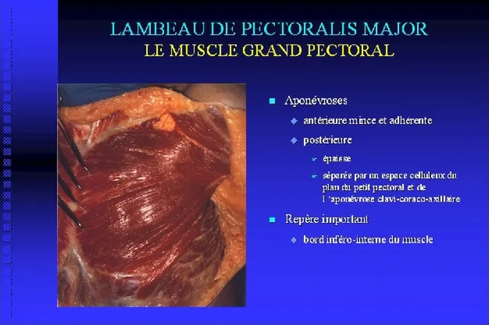 Lambeau de pectoralis major — figure 5