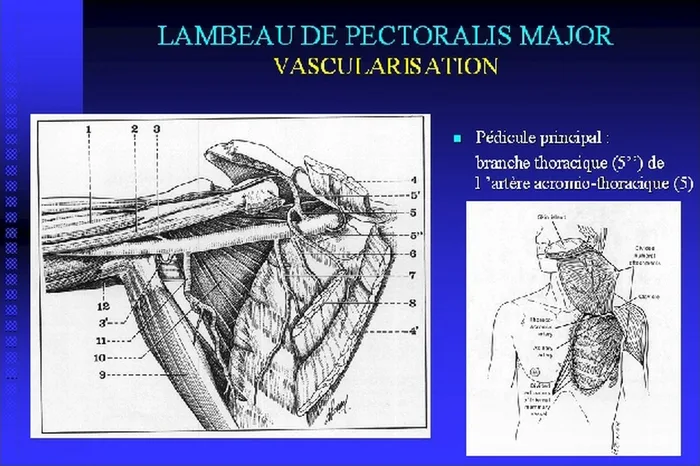 Lambeau de pectoralis major — figure 7