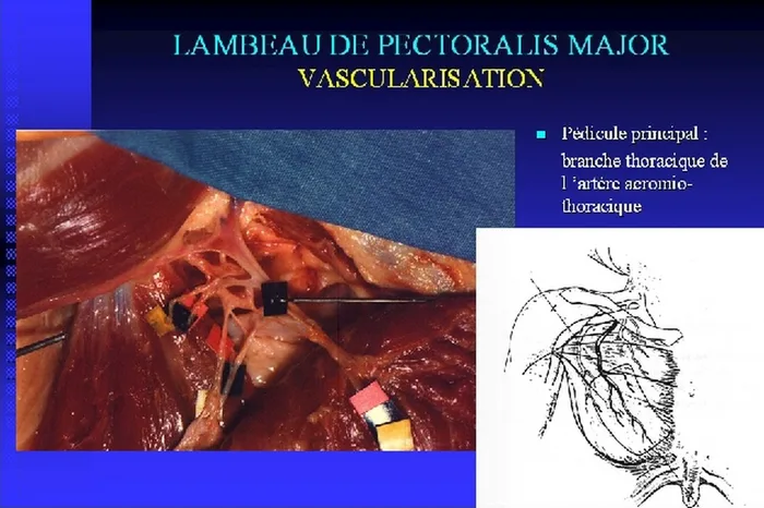Lambeau de pectoralis major — figure 8