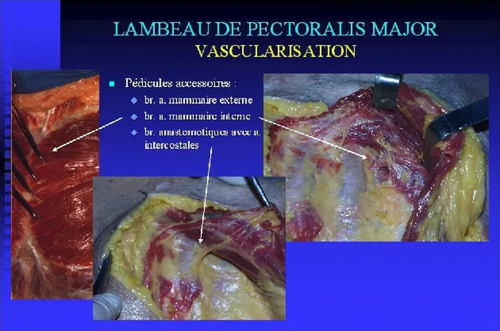 Lambeau de pectoralis major — figure 9