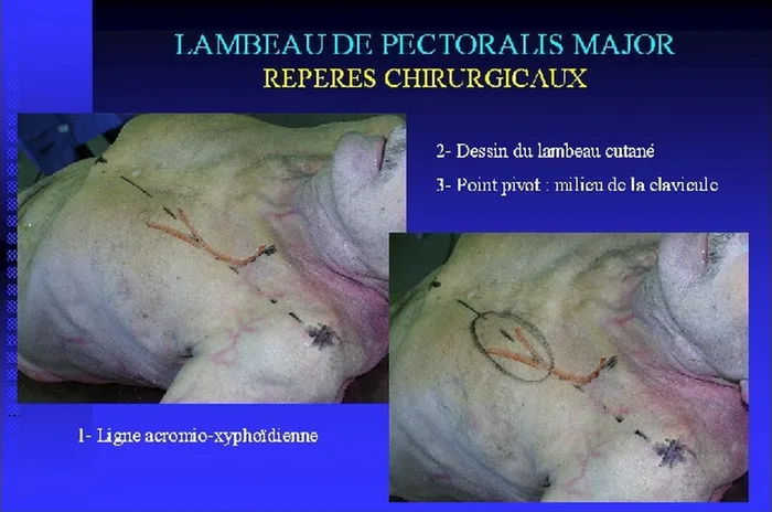 Lambeau de pectoralis major — figure 10
