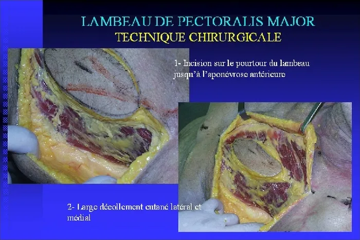 Lambeau de pectoralis major — figure 11