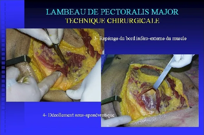 Lambeau de pectoralis major — figure 12