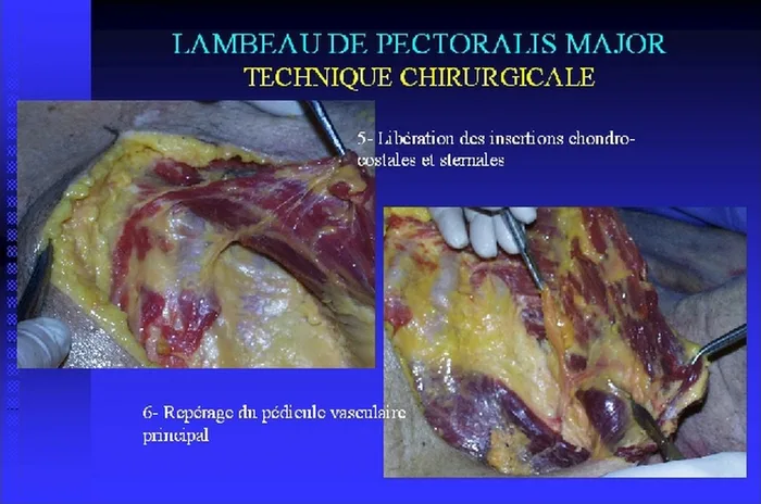 Lambeau de pectoralis major — figure 13
