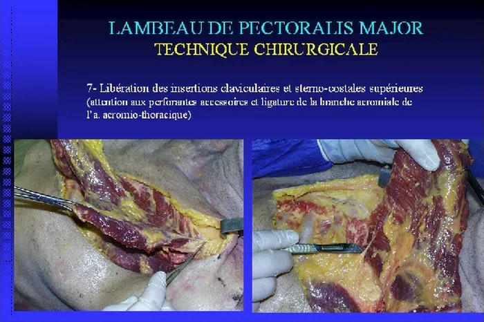 Lambeau de pectoralis major — figure 14