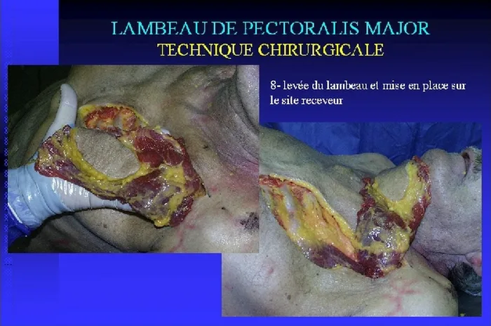 Lambeau de pectoralis major — figure 15