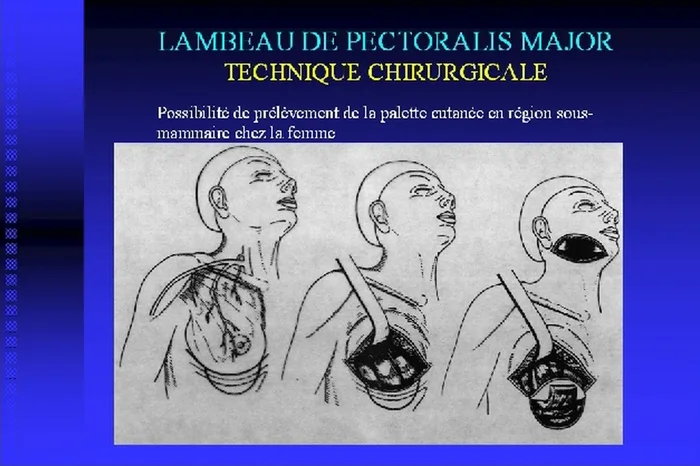 Lambeau de pectoralis major — figure 16