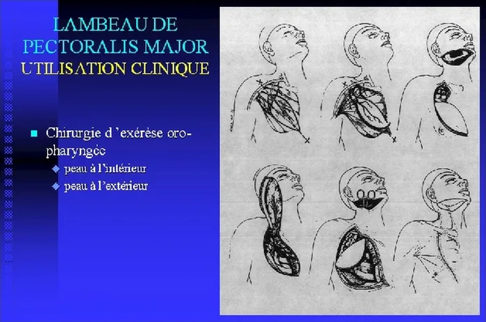 Lambeau de pectoralis major — figure 17