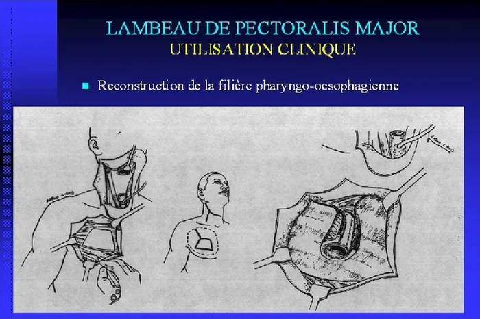 Lambeau de pectoralis major — figure 18