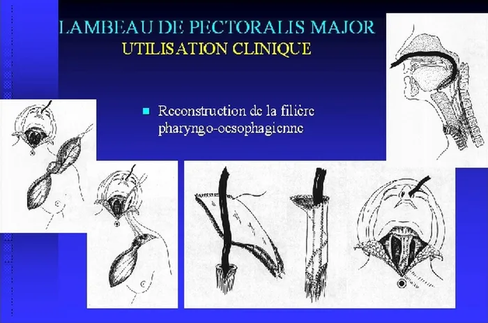 Lambeau de pectoralis major — figure 19