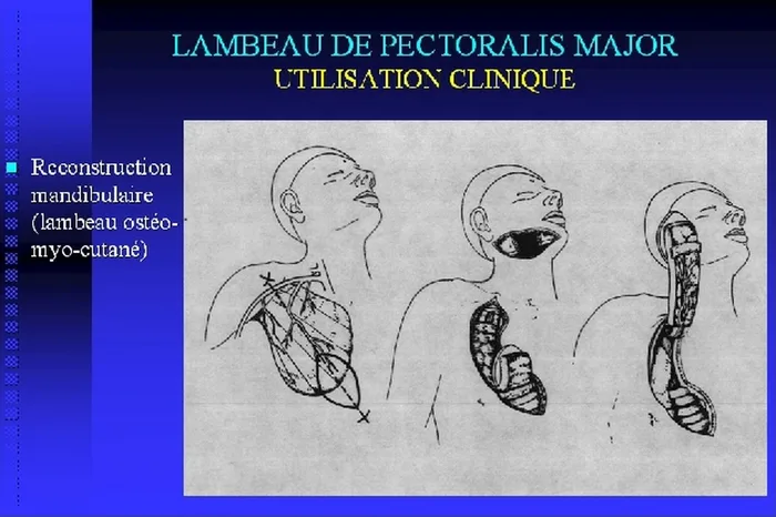 Lambeau de pectoralis major — figure 20