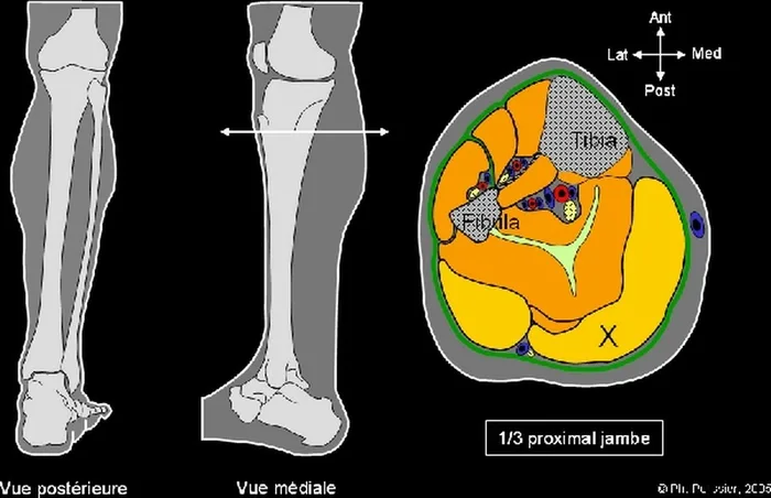 Lambeau de muscle gastrocnémien médial — figure 1