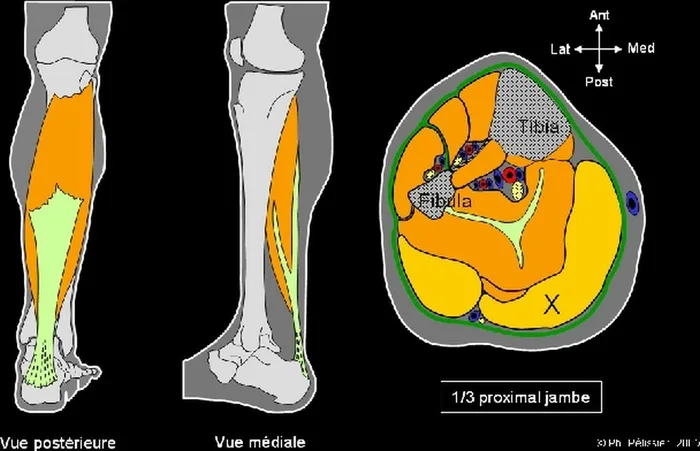 Lambeau de muscle gastrocnémien médial — figure 2