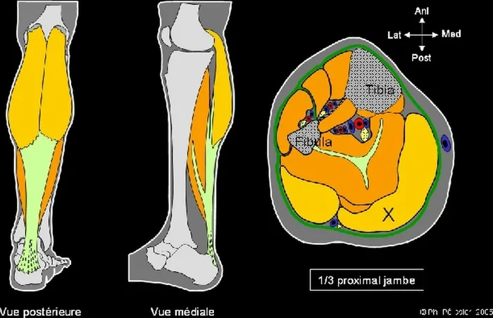 Lambeau de muscle gastrocnémien médial — figure 3