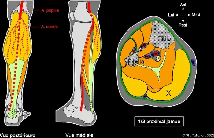Lambeau de muscle gastrocnémien médial — figure 4