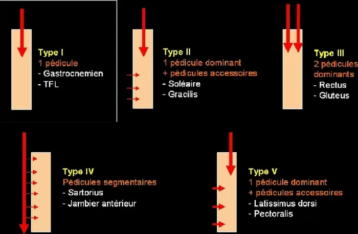 Lambeau de muscle gastrocnémien médial — figure 6