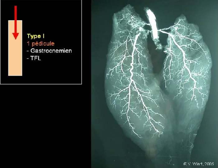 Lambeau de muscle gastrocnémien médial — figure 7