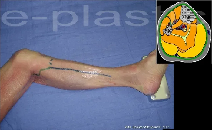 Lambeau de muscle gastrocnémien médial — figure 8