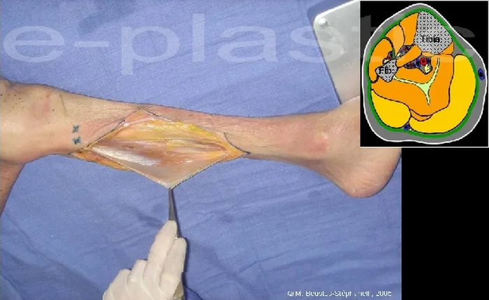 Lambeau de muscle gastrocnémien médial — figure 9