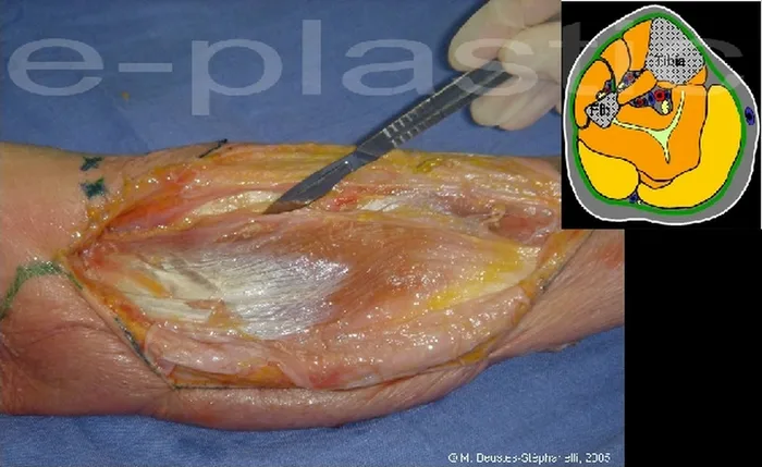 Lambeau de muscle gastrocnémien médial — figure 11