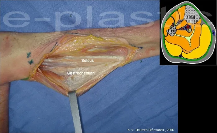 Lambeau de muscle gastrocnémien médial — figure 12