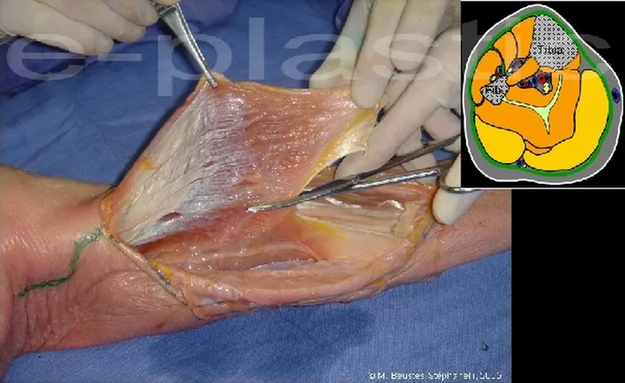 Lambeau de muscle gastrocnémien médial — figure 13